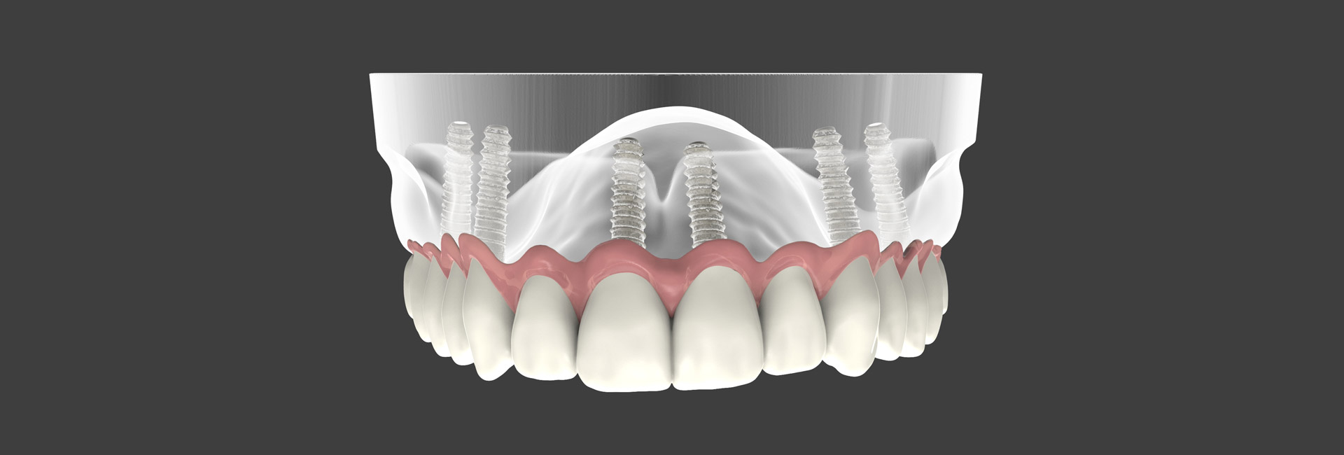 In which cases is implant application risky? | Medicadent Dental Clinic